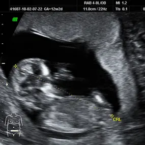 Ultraschallbild von Baby